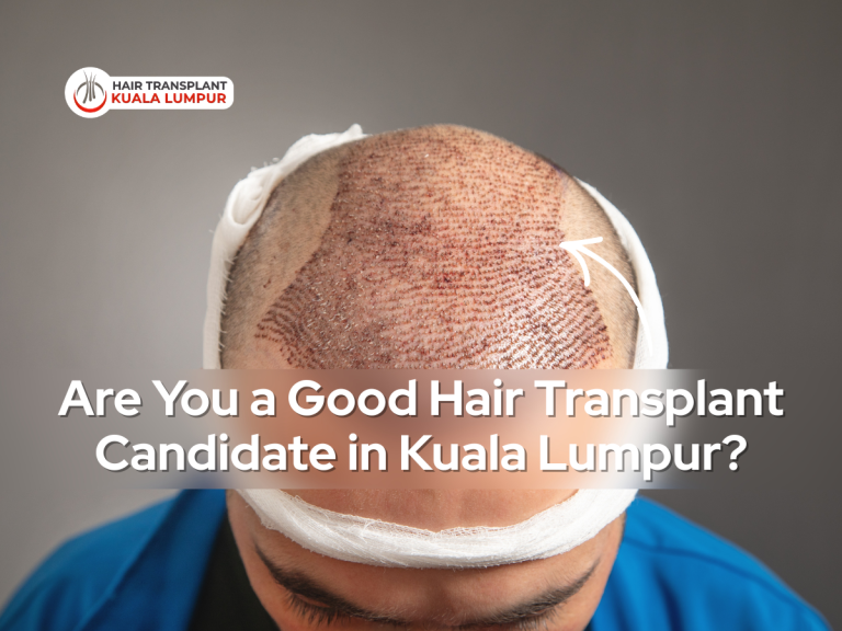 Are You a Good Hair Transplant Candidate in Kuala Lumpur
