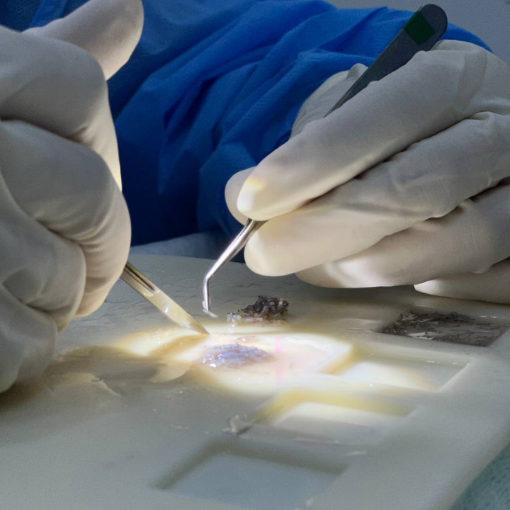 FUE Malaysia - Graft Procedure
