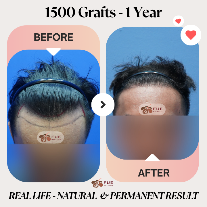 FUE Malaysia - Real Life Real Results - 1500 Grafts - 1 Year