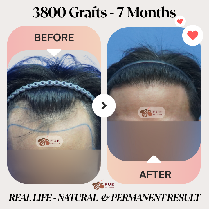 FUE Malaysia - Real Life Real Results - 3800 Grafts - 7 Months