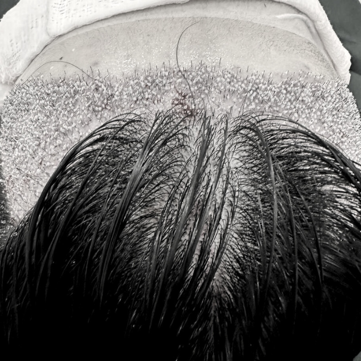Female Hair Transplant