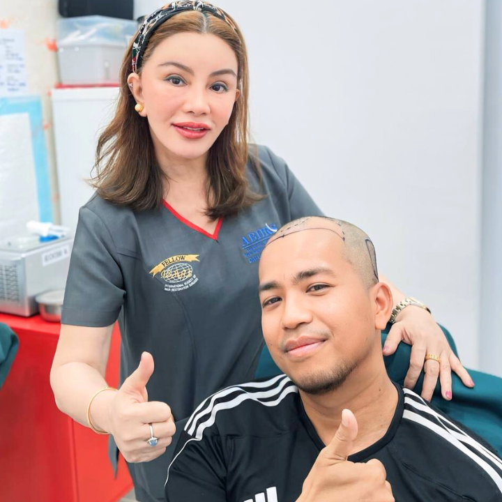 M-Shape Hair Transplant (5)
