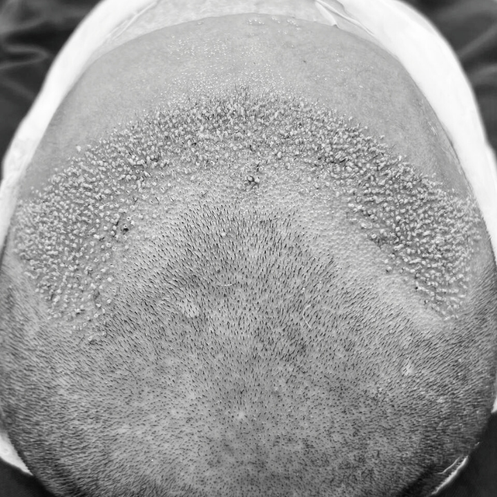 M-Shape Hair Transplant